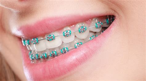 does all metal braces brackets need wire|orthopedic wire for braces.